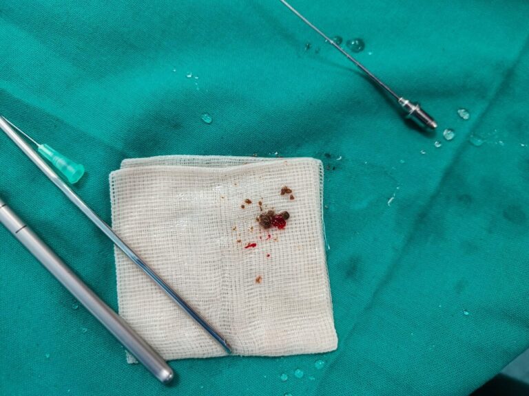 kidney stones with instruments