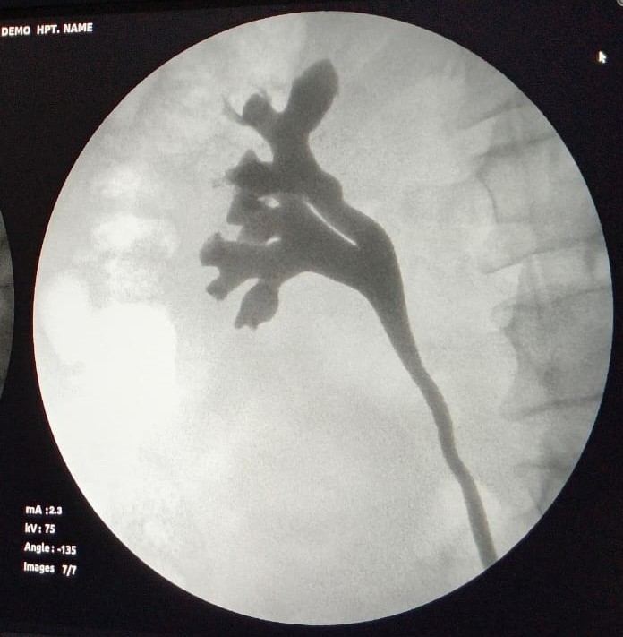 C arm image showing the left kidney and ureter, pelvicalyceal system delineated with contrast