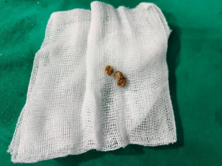 Extracted Renal/Ureteric calculus (stone) placed on a white gauze piece on the background of a green instrument trolley