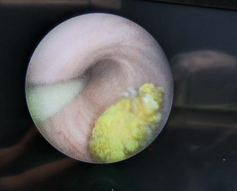 URS Ureteroscopy showing a guidewire and ureteric calculus